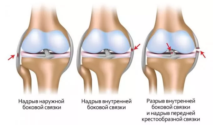 Растяжение связок коленного сустава (правое колено, вид спереди)